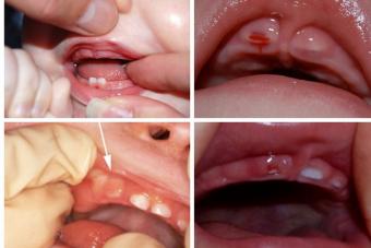 Зубы у детей: порядок прорезывания, сроки прорезывания зубов