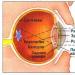 Симптомы катаракты у взрослых Катаракта причины возникновения симптомы